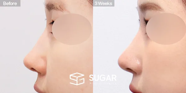 슈가성형외과 재) 재수술 + 매부리코 + 비공 내리기 + 귀 뒤 근막 전후사진 - 측면 수술 전후 비교