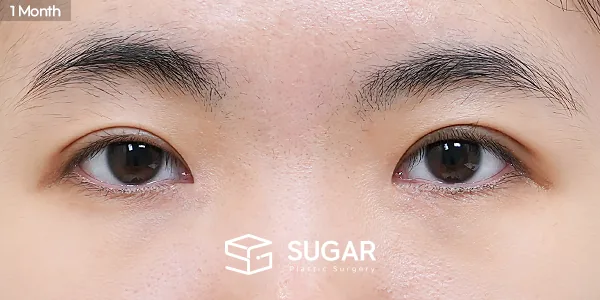 슈가성형외과 첫) 자연유착 + 눈매교정 + 윗트임 + 앞트임 전후사진 - 수술 후