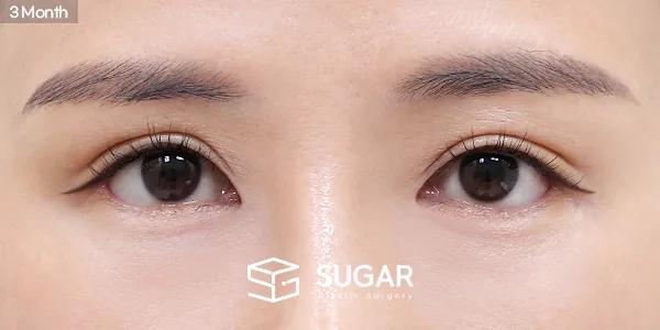 슈가성형외과 첫) 뒤밑트임 전후사진 - 수술 후