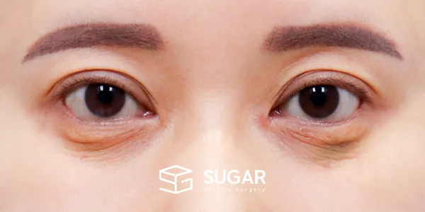 슈가성형외과 재) 재수술 + 중안부면부 거상 + 하안검 + 절개 + 눈매교정 전후사진 - 수술 전
