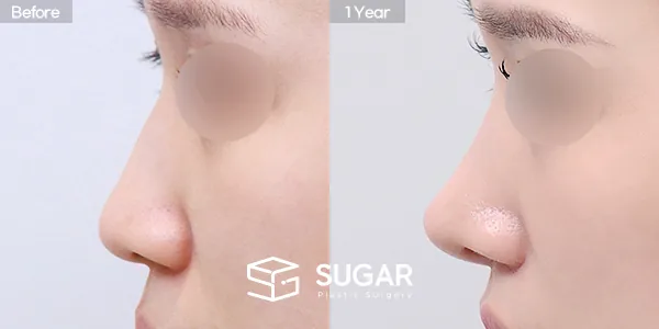 슈가성형외과 첫) 무보형물 + 절골 + 매부리 + 복코 + 귀 뒤 근막 + 귀연골 + 비중격연장 전후사진 - 측면 수술 전후 비교