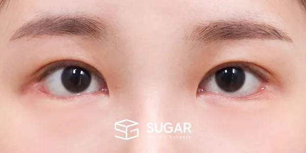 슈가성형외과 첫) 절개(두 줄 따기) + 눈매교정 + 2Point 뒤밑트임 전후사진 - 수술 후