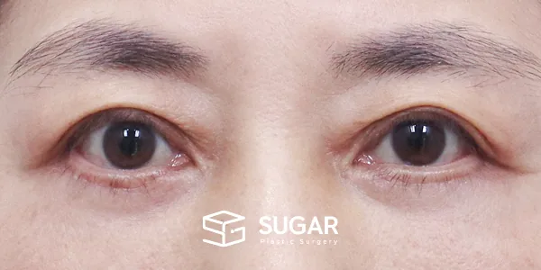 슈가성형외과 첫) 중안면부 거상 + 하안검 전후사진 - 수술 후
