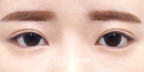 슈가성형외과 재) 절개 재수술 + 눈매교정 + 윗트임 + 뒤밑트임 + 안검내반 전후사진 - 수술 후