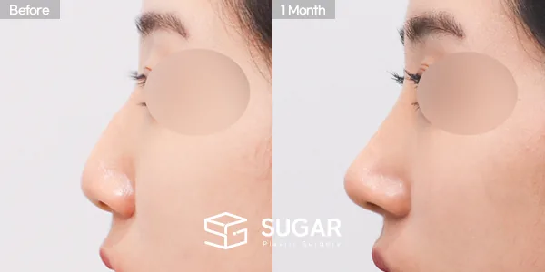 슈가성형외과 첫) 콧대 + 코끝 + 복코 + 매부리코 + 무보형물 코성형 + 절골 + 기증늑 전후사진 - 측면 수술 전후 비교
