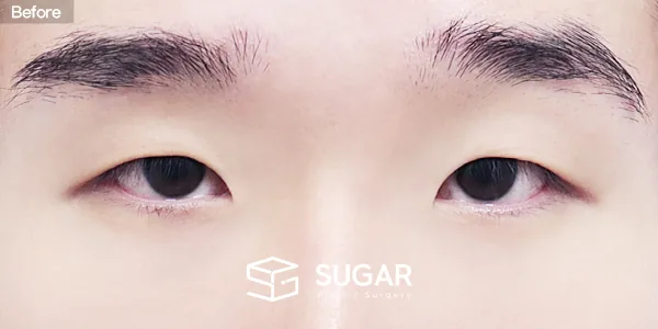 슈가성형외과 첫) 자연유착 + 눈매교정 + 윗트임 + 앞트임 + 뒤밑트임 전후사진 - 수술 전