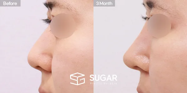 슈가성형외과 첫) 콧대 + 코끝 + 비중격연골 + 귀연골 + 매부리 + 절골 + 휜코 + 복코 + 비공내리기 전후사진 - 측면 수술 전후 비교