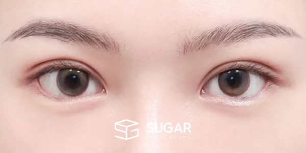 슈가성형외과 첫) 자연유착 + 눈매교정 + 윗트임 + 뒤밑트임 + 눈 밑 지방재배치 전후사진 - 수술 후