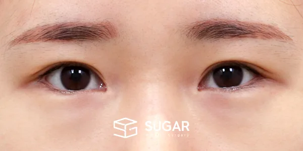 슈가성형외과 재) 재수술 + 뒤밑트임 전후사진 - 수술 전