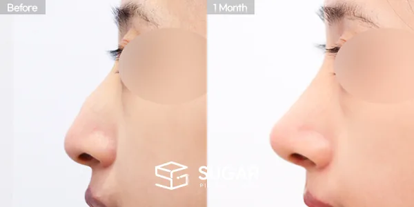 슈가성형외과 첫) 콧대 + 코끝 + 매부리코 + 무보형물 코성형 + 휜코 + 절골 + 비주교정 + 비중격 전후사진 - 측면 수술 전후 비교