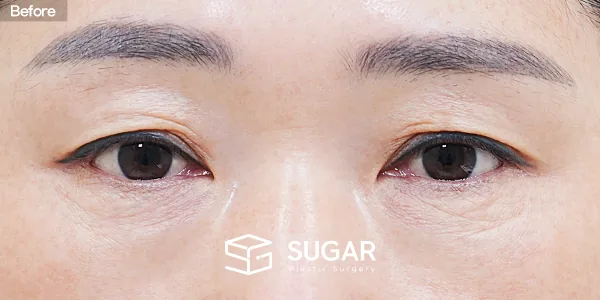 슈가성형외과 첫) 눈썹하거상술 + 자연유착 전후사진 - 수술 전