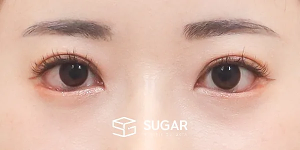 슈가성형외과 재) 재수술 + 2Point 웨이브 뒤밑트임 전후사진 - 수술 후