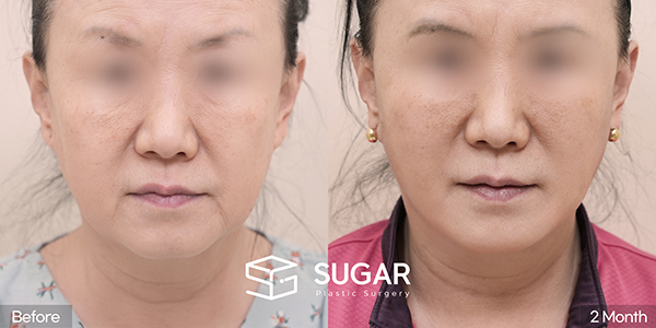 슈가성형외과 첫) 안면거상 + 자연유착 + 하안검 + 눈썹거상 전후사진 - 정면 수술 전후 비교