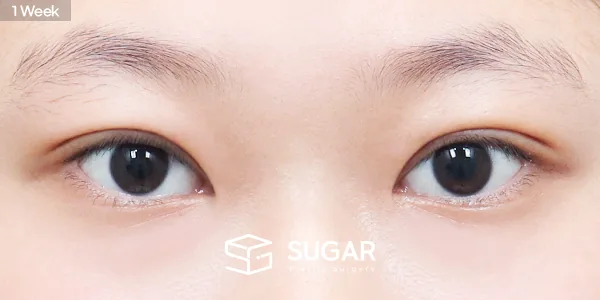 슈가성형외과 첫) 자연유착 + 눈매교정 + 윗트임 전후사진 - 수술 후