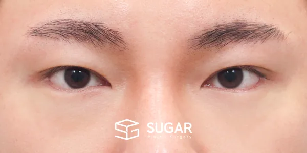 슈가성형외과 첫) 자연유착 + 눈매교정 + 밑트임 전후사진 - 수술 후