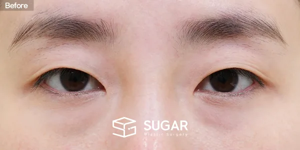 슈가성형외과 첫) 자연유착 + 눈매교정 + 윗트임 전후사진 - 수술 전