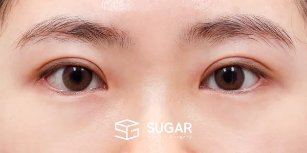슈가성형외과 첫) 절개 + 윗트임 + 뒤밑트임 전후사진 - 수술 후