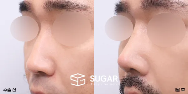 슈가성형외과 첫) 콧대코끝 + 매부리 + 휜코 + 절골 + 비중격 + 귀연골 전후사진 - 45도 수술 전후 비교