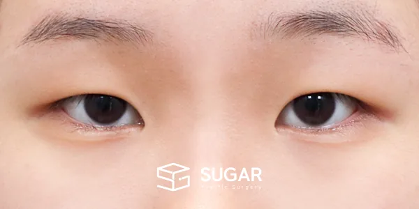 슈가성형외과 첫) 절개 + 눈매교정 + 앞트임 + 윗트임 + 눈 위 지방 제거 전후사진 - 수술 전