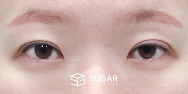 슈가성형외과 재) 재수술 + 절개 + 눈매교정 + 윗트임 전후사진 - 수술 전