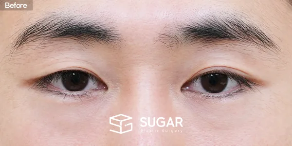 슈가성형외과 재) 재수술 + 자연유착 + 눈매교정 전후사진 - 수술 전