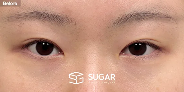 슈가성형외과 첫) 비절개눈매교정 + 윗트임 + 웨이브뒤밑트임 전후사진 - 수술 전