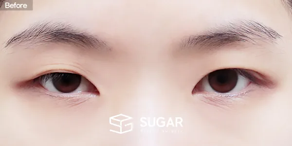 슈가성형외과 재) 재수술 + 자연유착 + 눈매교정 + 윗트임 + 뒤밑트임 전후사진 - 수술 전