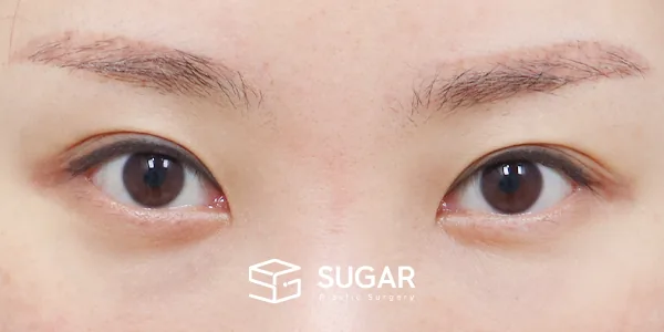 슈가성형외과 첫) 자연유착 + 눈매교정 + 윗트임 + 뒤밑트임 전후사진 - 수술 전