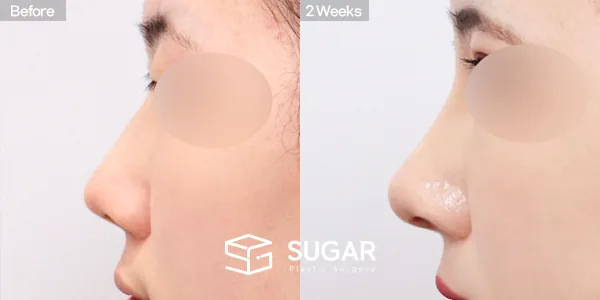 슈가성형외과 첫) 콧대 + 코끝 + 매부리코 전후사진 - 측면 수술 전후 비교