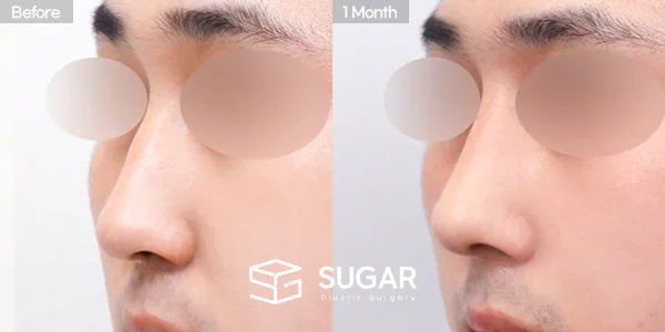 슈가성형외과 첫) 콧대 + 코끝 + 매부리코 + 절골 + 비주 지지 전후사진 - 45도 수술 전후 비교