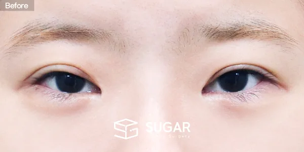 슈가성형외과 재) 재수술 + 절개 + 눈매교정 + 뒤밑트임 전후사진 - 수술 전