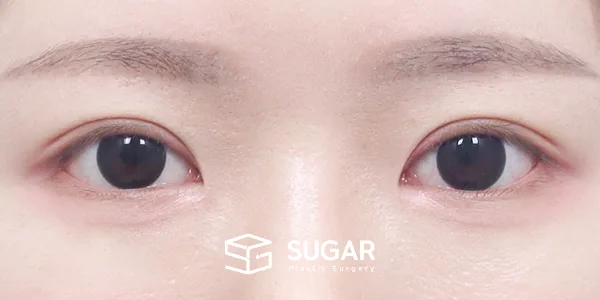 슈가성형외과 재) 재수술 + 자연유착 + 눈매교정 + 앞트임 + 윗트임 + 눈 두덩이 지방 제거 전후사진 - 수술 후