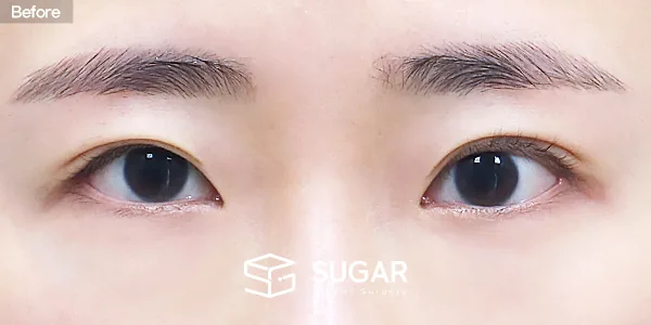 슈가성형외과 재) 재수술 + 자연유착 + 눈매교정 + 윗트임 전후사진 - 수술 전