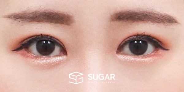 슈가성형외과 첫) 자연유착 + 눈매교정 + 윗트임 + 뒤밑트임 전후사진 - 수술 후