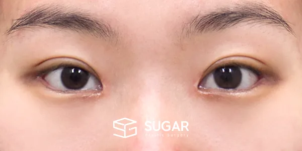 슈가성형외과 첫) 자연유착 + 눈매교정 + 앞트임 + 뒤밑트임 전후사진 - 수술 후