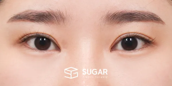 슈가성형외과 첫) 뒤밑트임 전후사진 - 수술 전