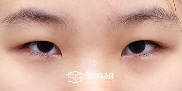 슈가성형외과 첫) 절개 + 앞트임 + 윗트임 전후사진 - 수술 전