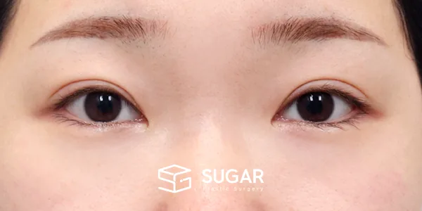 슈가성형외과 첫) 뒤밑트임 전후사진 - 수술 전