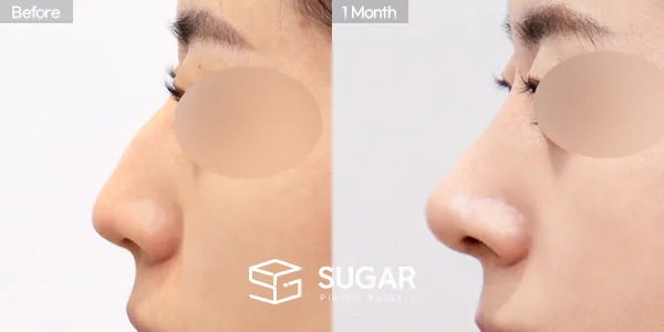 슈가성형외과 첫) 코끝 + 매부리코 + 무보형물 코성형 + 절골 + 귀 뒤 근막 전후사진 - 측면 수술 전후 비교