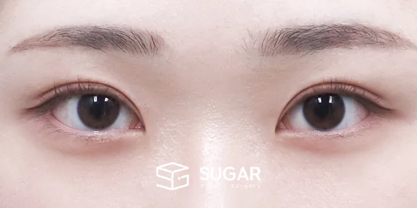 슈가성형외과 첫) 절개 + 윗트임 전후사진 - 수술 후