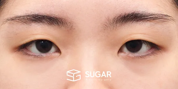 슈가성형외과 첫) 자연유착 + 눈매교정 + 앞트임 전후사진 - 수술 전
