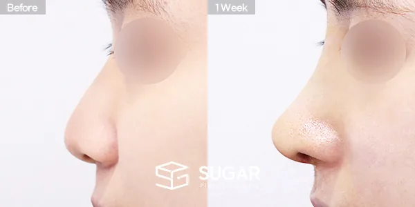 슈가성형외과 첫) 무보형물 + 비중격연골 + 귀연골 + 귀 뒤 근막 + 복코 + 매부리 + 절골 + 비주연장 전후사진 - 측면 수술 전후 비교