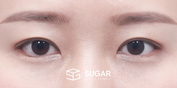 슈가성형외과 첫) 자연유착 + 눈매교정 + 뒤밑트임 전후사진 - 수술 후