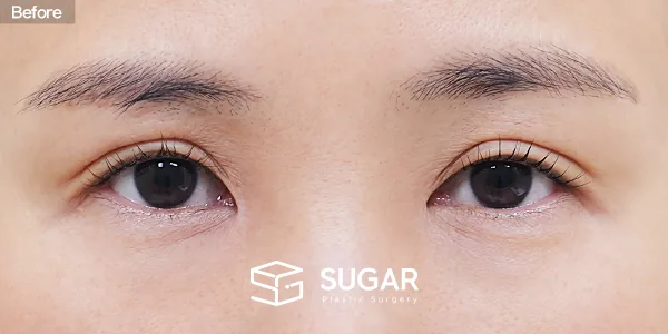 슈가성형외과 첫) 뒤밑트임 전후사진 - 수술 전
