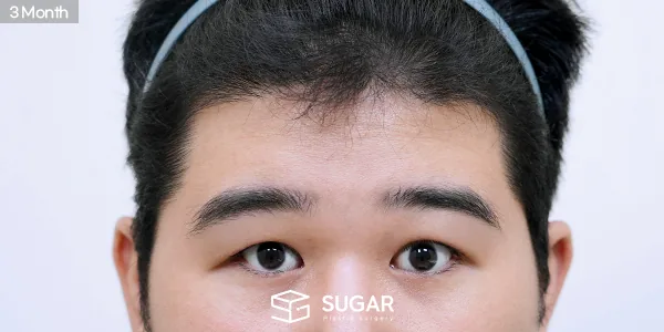 슈가성형외과 첫) 이마거상 + 절개 + 눈매교정 + 눈 두덩이 지방 제거 전후사진 - 수술 후
