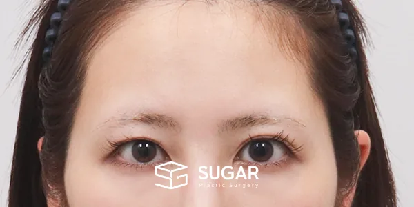 슈가성형외과 재) 이마거상 + 절개 재수술 전후사진 - 전후 비교 사진