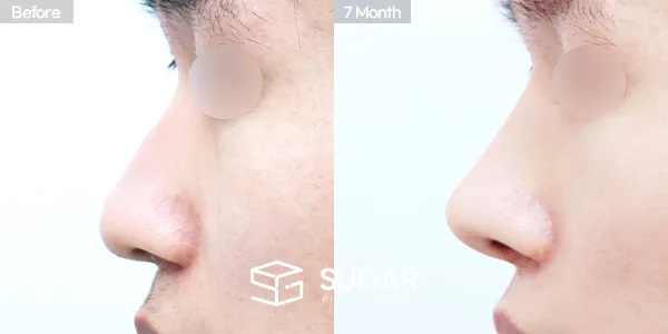 슈가성형외과 첫) 콧대 + 코끝 + 비중격연골 + 귀연골 + 매부리 + 복코 전후사진 - 측면 수술 전후 비교