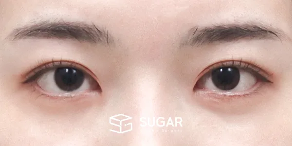 슈가성형외과 첫) 절개 + 앞트임 + 뒤밑트임 전후사진 - 수술 후