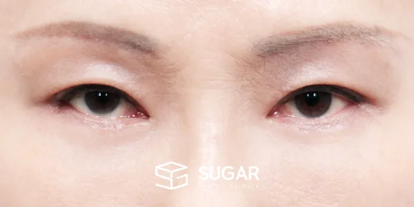 슈가성형외과 첫) 절개 + 눈썹하거상술 + 하안검 + 중안면부리프팅 전후사진 - 수술 후