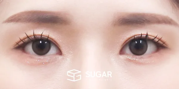슈가성형외과 재) 재수술 + 절개 + 눈매교정 + 윗트임[R] 전후사진 - 수술 후